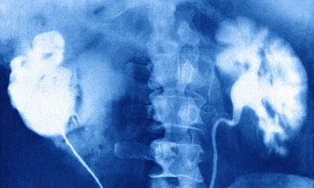 X-ray of damaged kidney