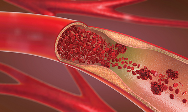 blood disorders in children