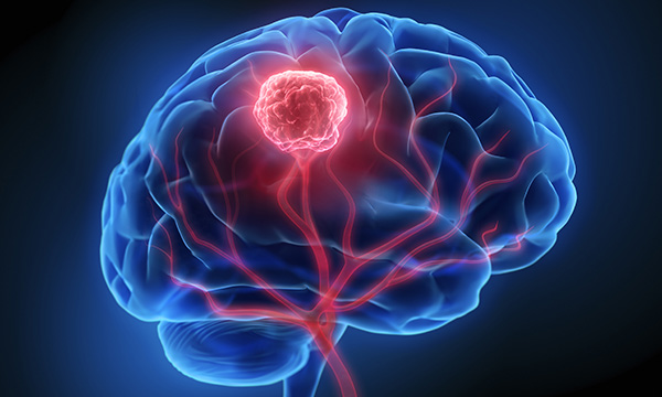 brain tumour