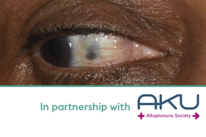 An-overview-of-Alkaptonuria-AKU-or-black-bone-disease