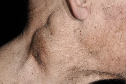 An-overview-of-non-Hodgkin-lymphoma