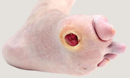 Assessment-and-management-of-patients-with-diabetes-related-foot-ulcers