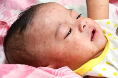 Measles-pathology-management-and-public-health-issues