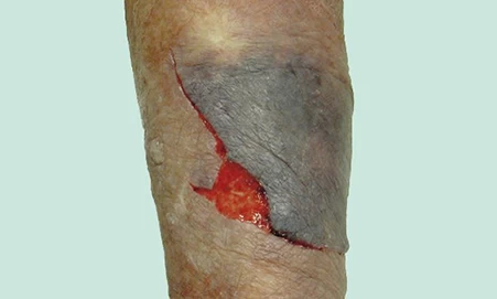 Preventingassessingandtreatingskintears