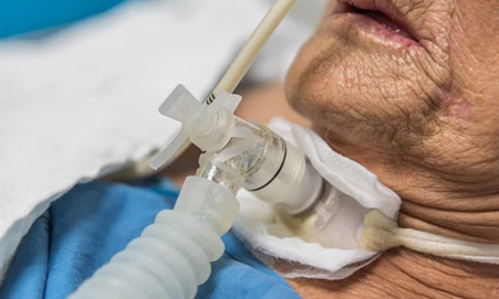 Tracheostomycaretheroleofthenursebefo