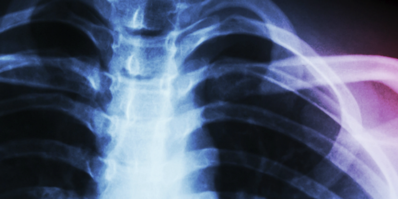 xray of spine