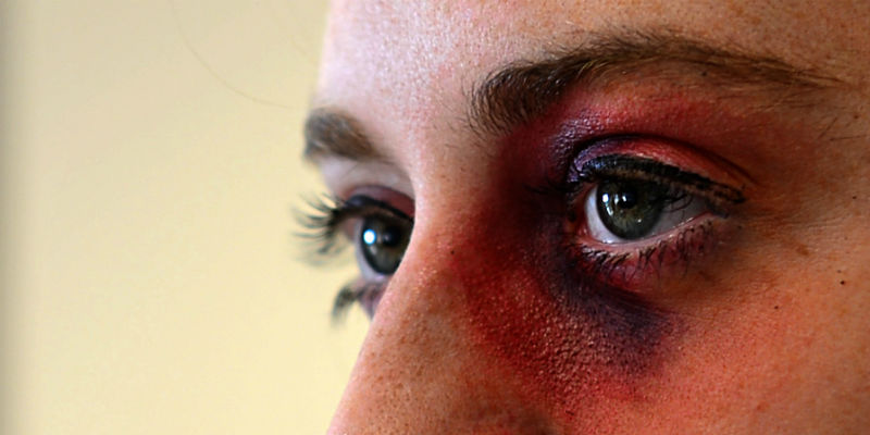 Woman with a black eye