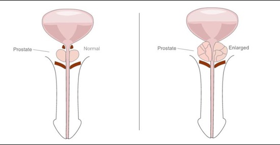 Enlarged prostate