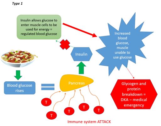 Type 1 diabetes