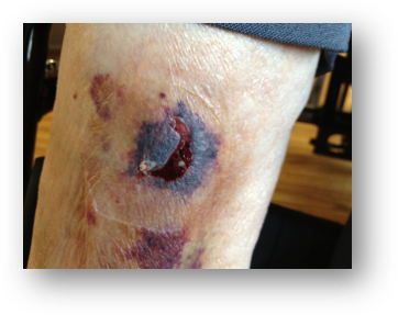 Lower Limb skin tear