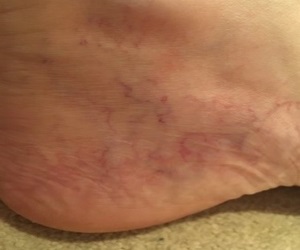 Corona phlebectatica on a persons ankle