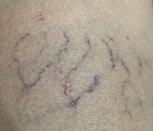 Telangiectasis Spider veins on a persons leg