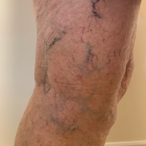 Varicose veins on a persons leg