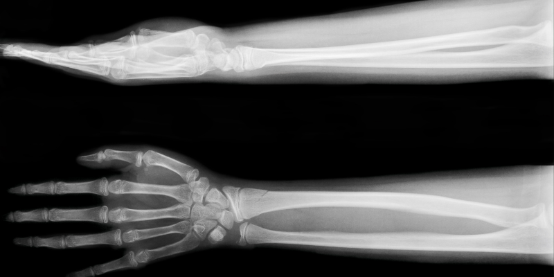 X-ray style graphic of an arm