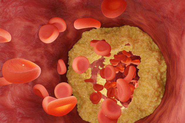 Illustration shows inside a blood vessel. Red blood cells flow, partially obstructed by yellow plaques which have attached to the vessel wall