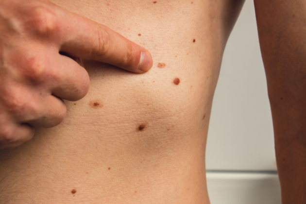 Man pointing at mole on upper torso