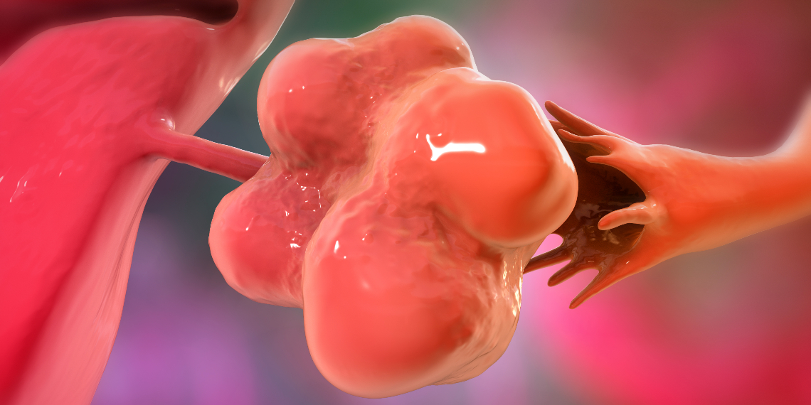 A computer illustration shows an enlarged left ovary with cysts, representing a story on polycystic ovary syndrome, known as PCOS