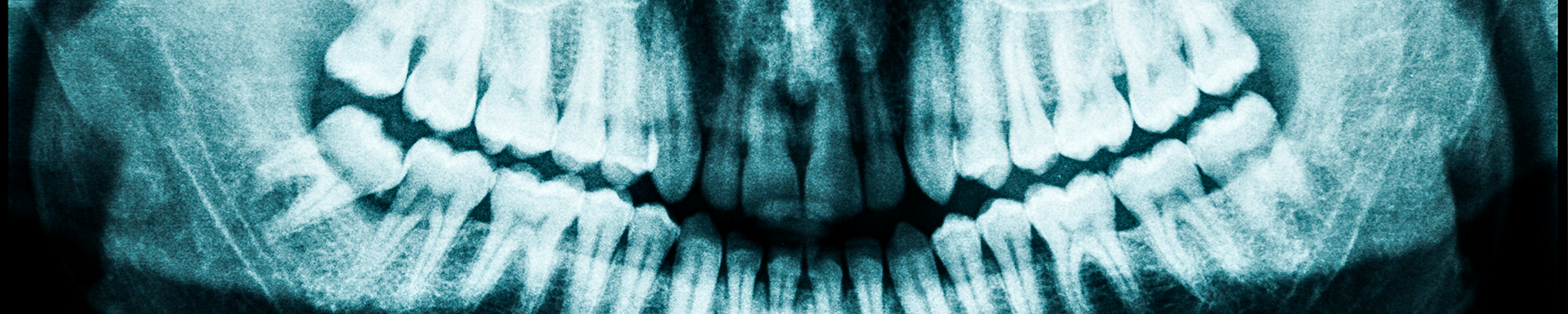 X ray of jaw and teeth