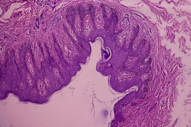 Microscope image shows endometriosis scar tissue