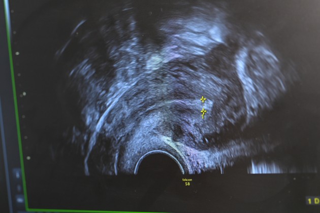 Photo of screen showing black and white image of a uterus scan image