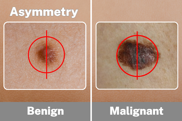 Comparison of an asymmetric malignant mole and a symmetric benign mole