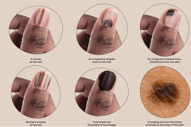Images showing how melanoma presents differently in darker skin tones