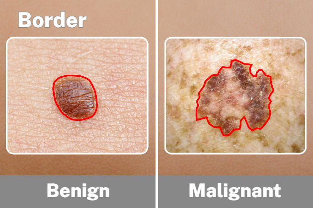 Comparison of a mole with a smooth border to a malignant mole with jagged edges