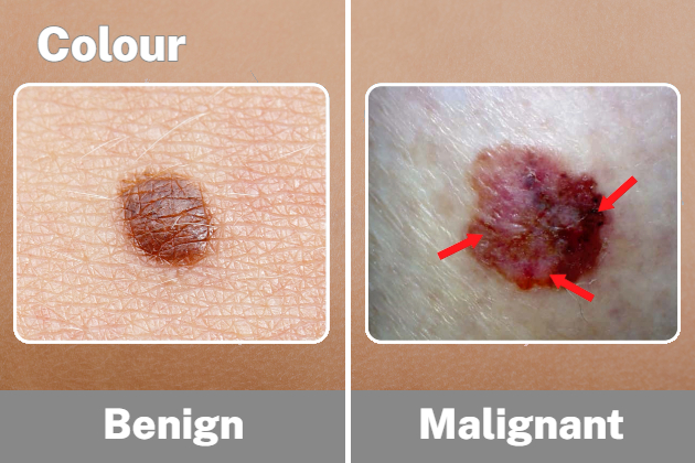 Comparison of a healthy mole to a malignant mole, with arrows highlighting different pigments