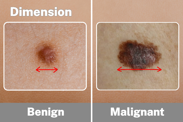 measurement of a benign mole in comparison to a malignant mole