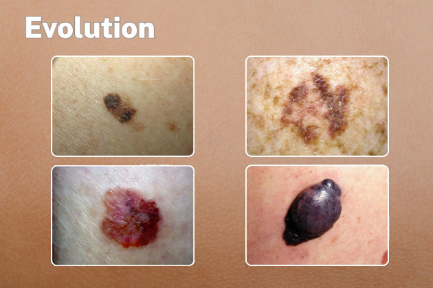 Moles that are evolving and may be itchy, oozing or beginning to become crusty