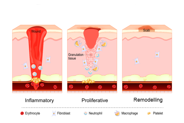 Illustration showing three stages of wound healing: inflammatory, proliferation and remodelling