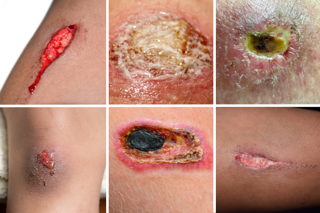 A composite image showing six examples of wounds on different skin tones