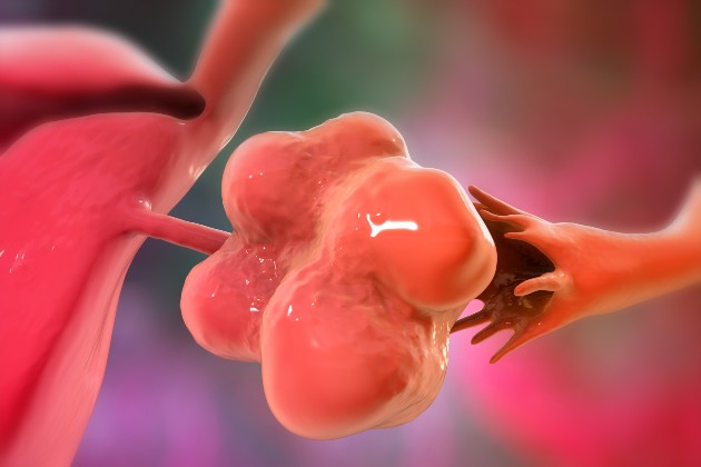 A computer illustration shows an enlarged left ovary with cysts, representing PMOS, formerly known as PCOS