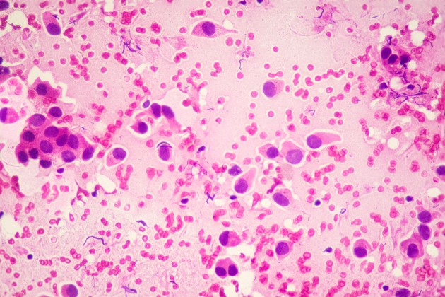 Microscopic image breast cancer