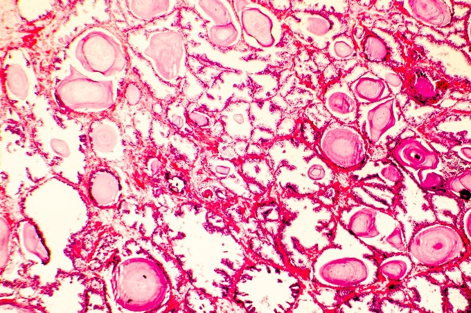 Photomicrograph of prostate hyperplasia