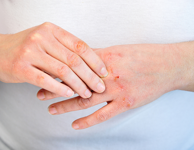 Hand dermatitis