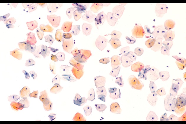 An image of health cervical cells taken from a pap or smear test