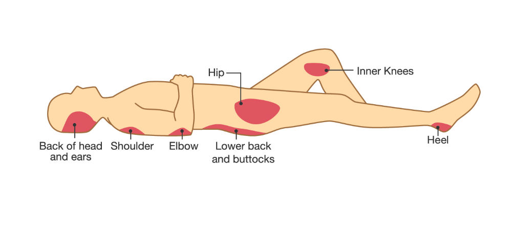 Body showing pressure ulcer points